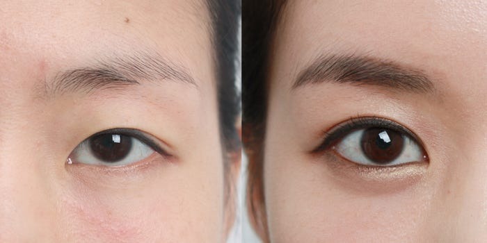 Korea Plastic Surgery The Global Standard for Beauty and Precision